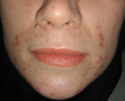remove acne scars